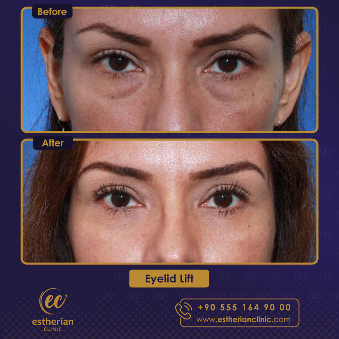 Eyelid Lift Before and After