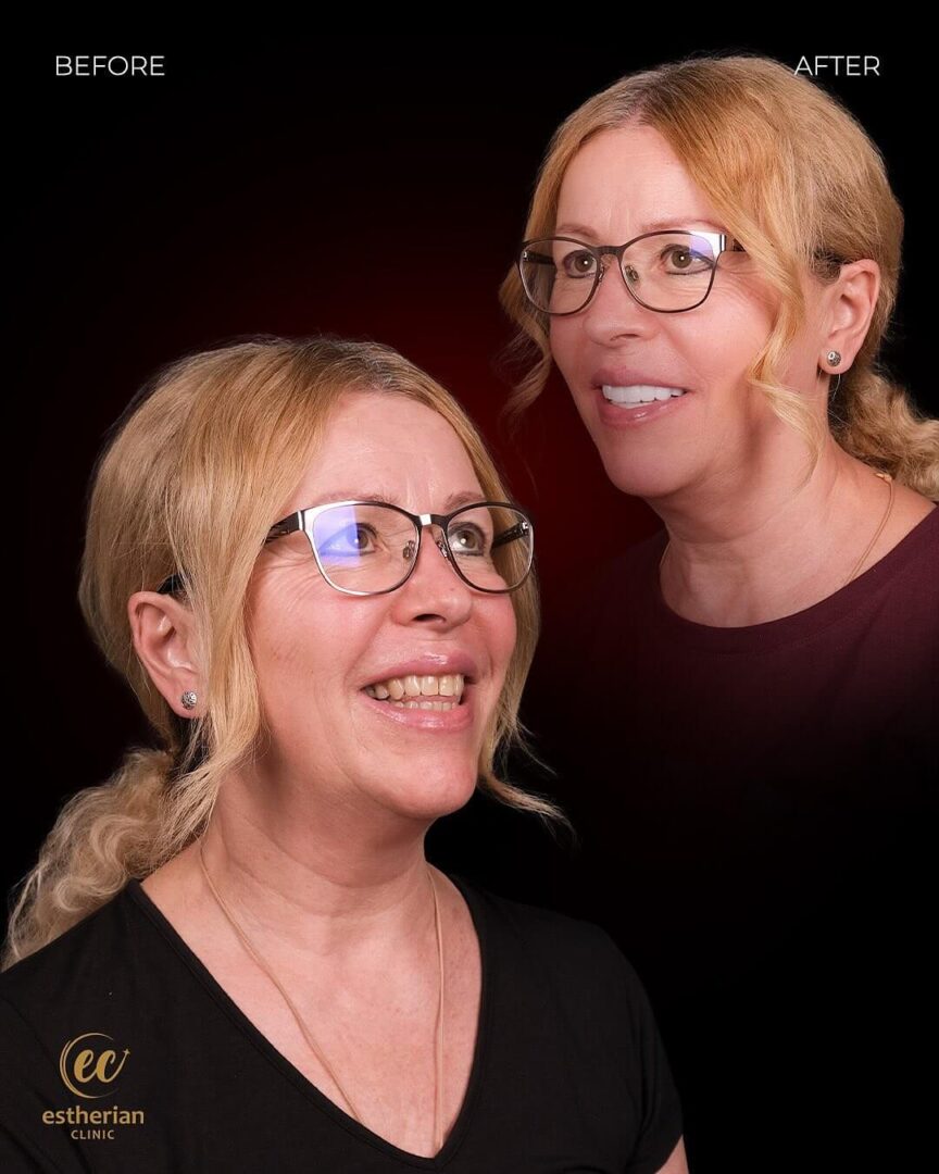 26 Teeth with the Monolithic Zirconium for the Hollywood Smile by the Estherian Clinic  (before and after)
