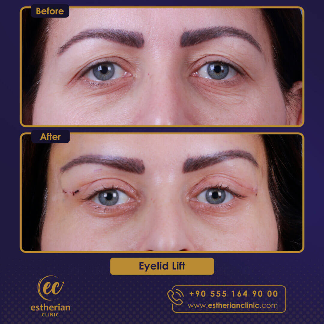 Eyelid Lift Before and After