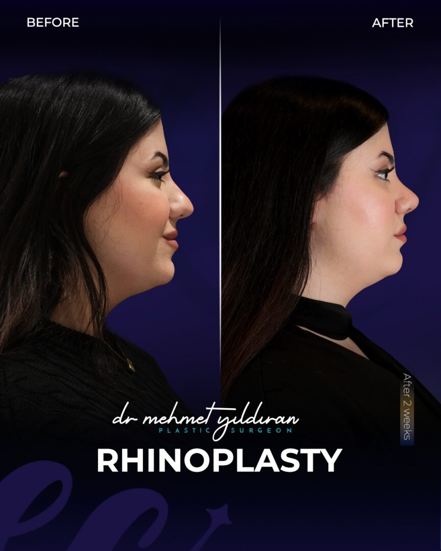 A Rhinoplasty by Dr. Mehmet Yildiran (2-weeks Post-op)
