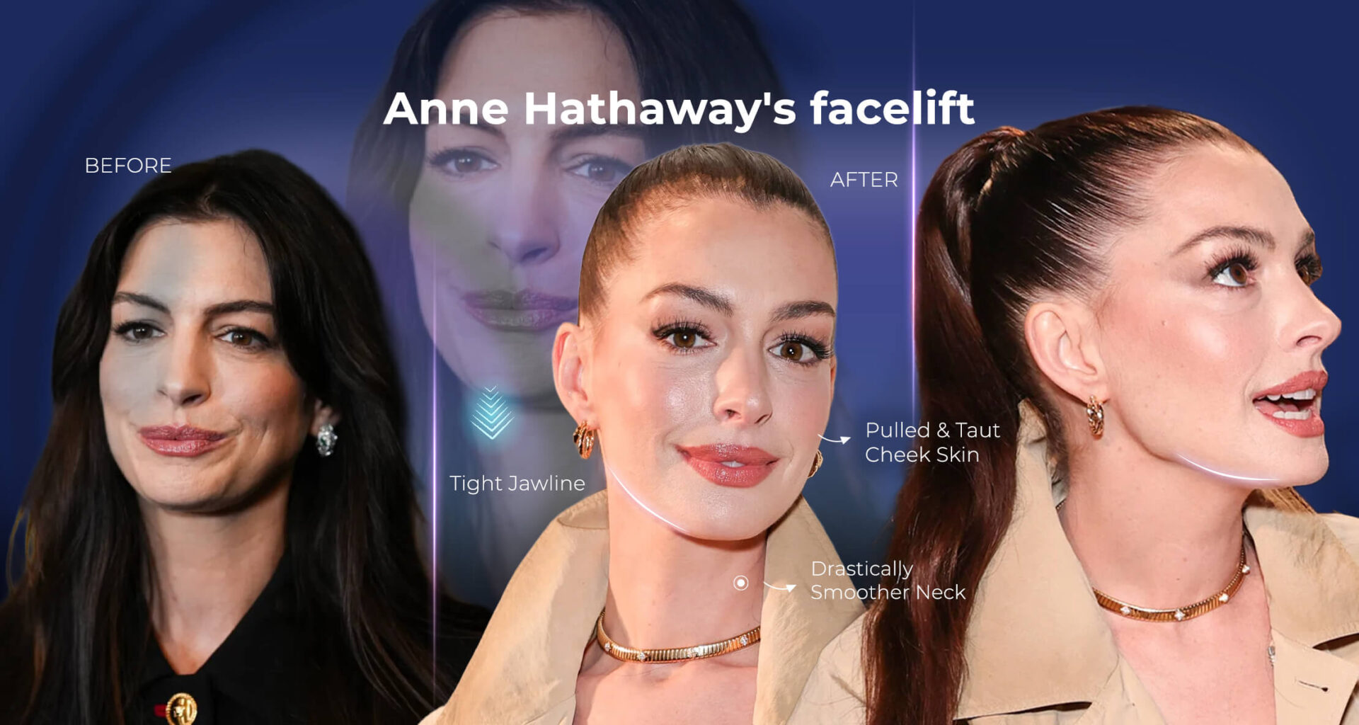 Infogrpahic: Anne Hathaway's before and after facelift