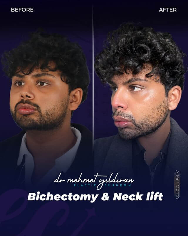 Bicectomy and Neck lift by Dr. Mehmet Yildiran (before and after)