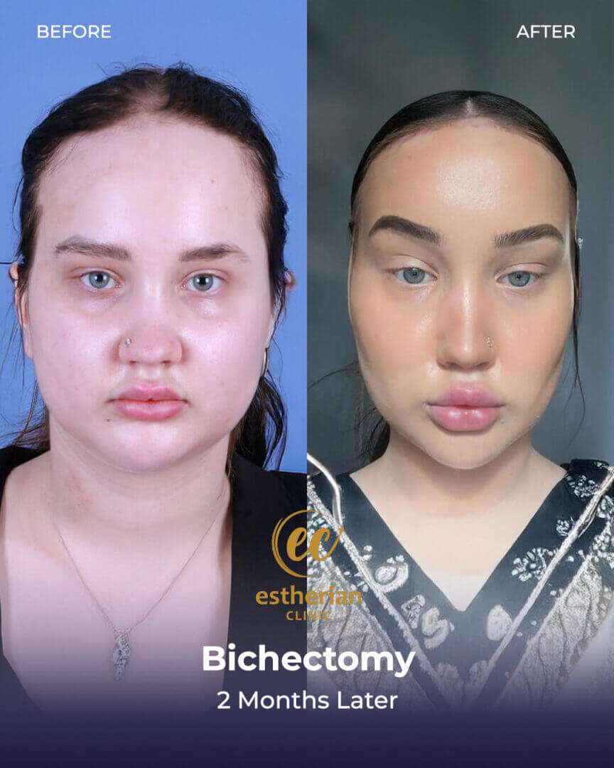 (Buccal fat removal results: 2 months later)