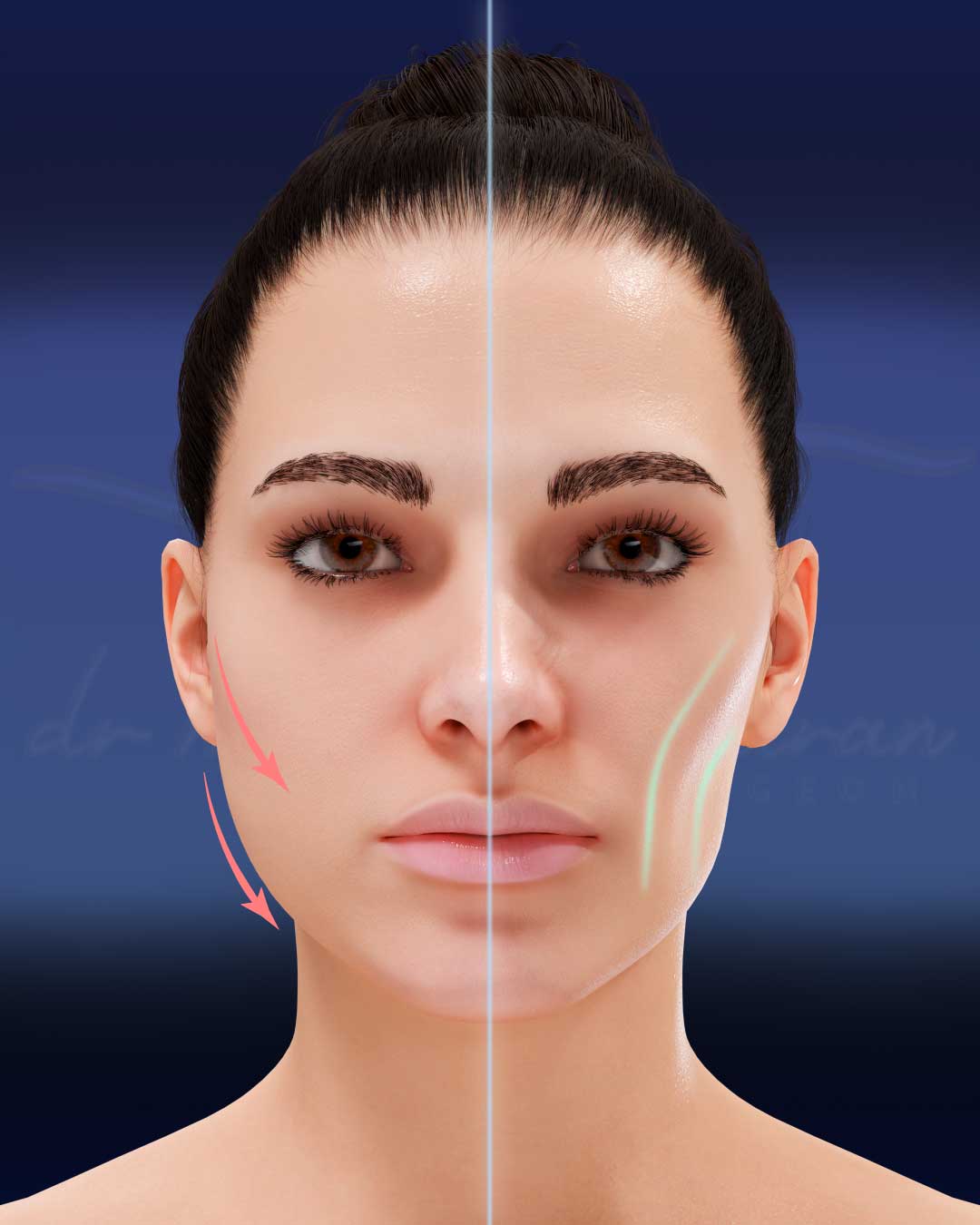 Bichectomy-Buccal-Fat-Removal