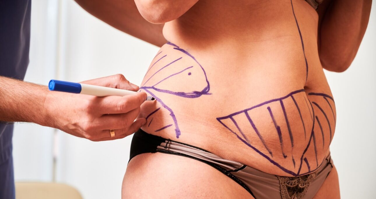 Body Contouring Surgery: Your Body, Refined