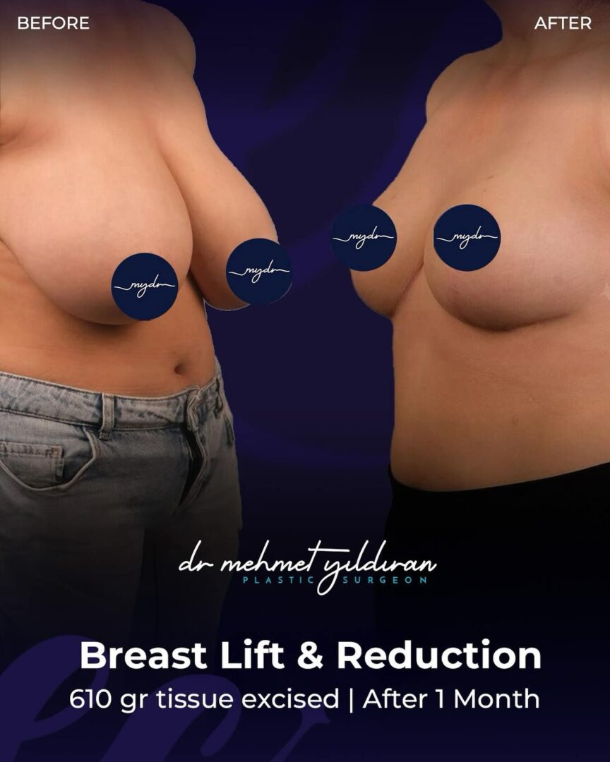 Breast Lift and Reduction (610 gr tissue excised) results after 1 month