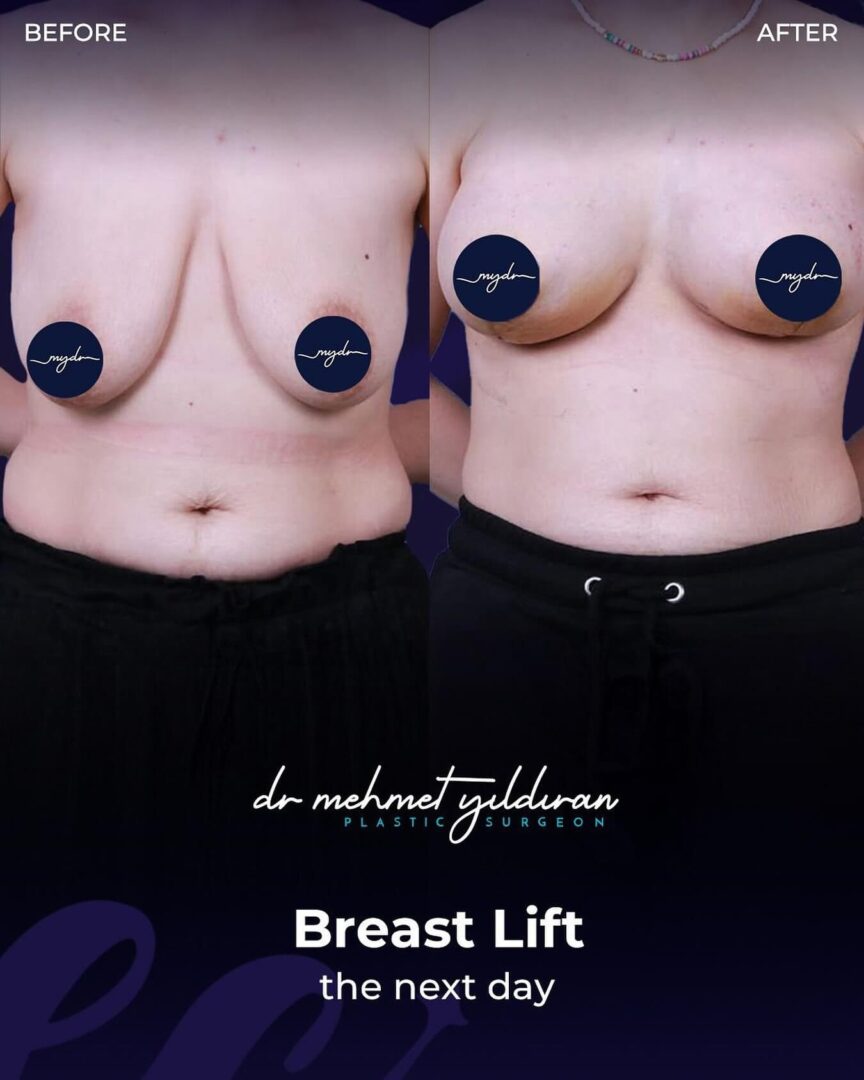 Breast Lift (results the next day)