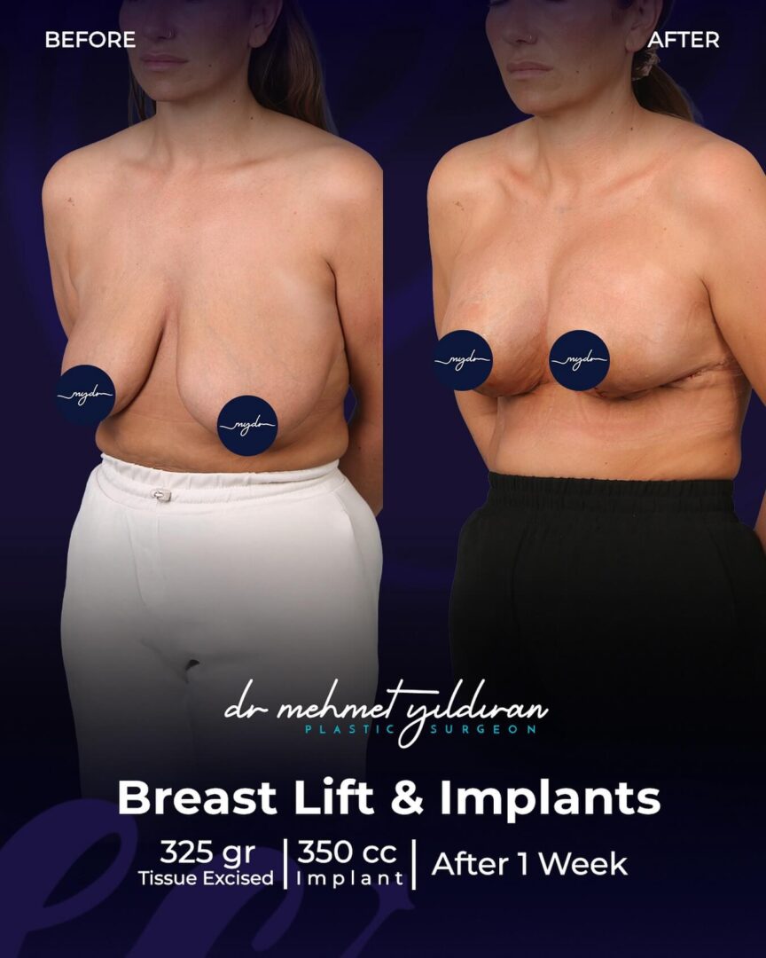 Breast Lift and Implant (before and after)