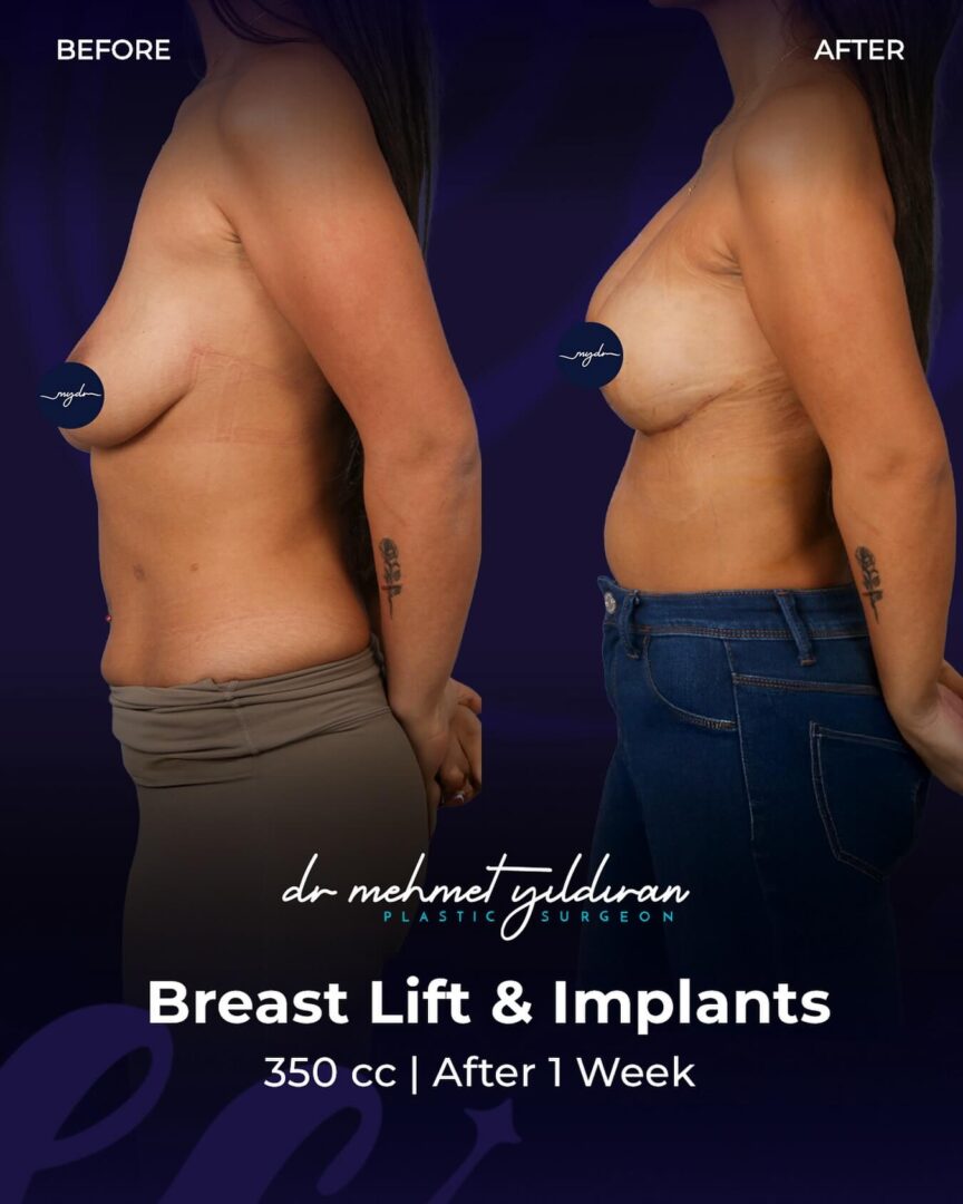 Breat Lift and Implants (before and after)