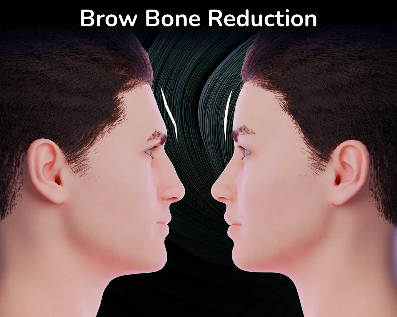 Brow Bone Reduction (3-D Inforgraphic) Before-and-after