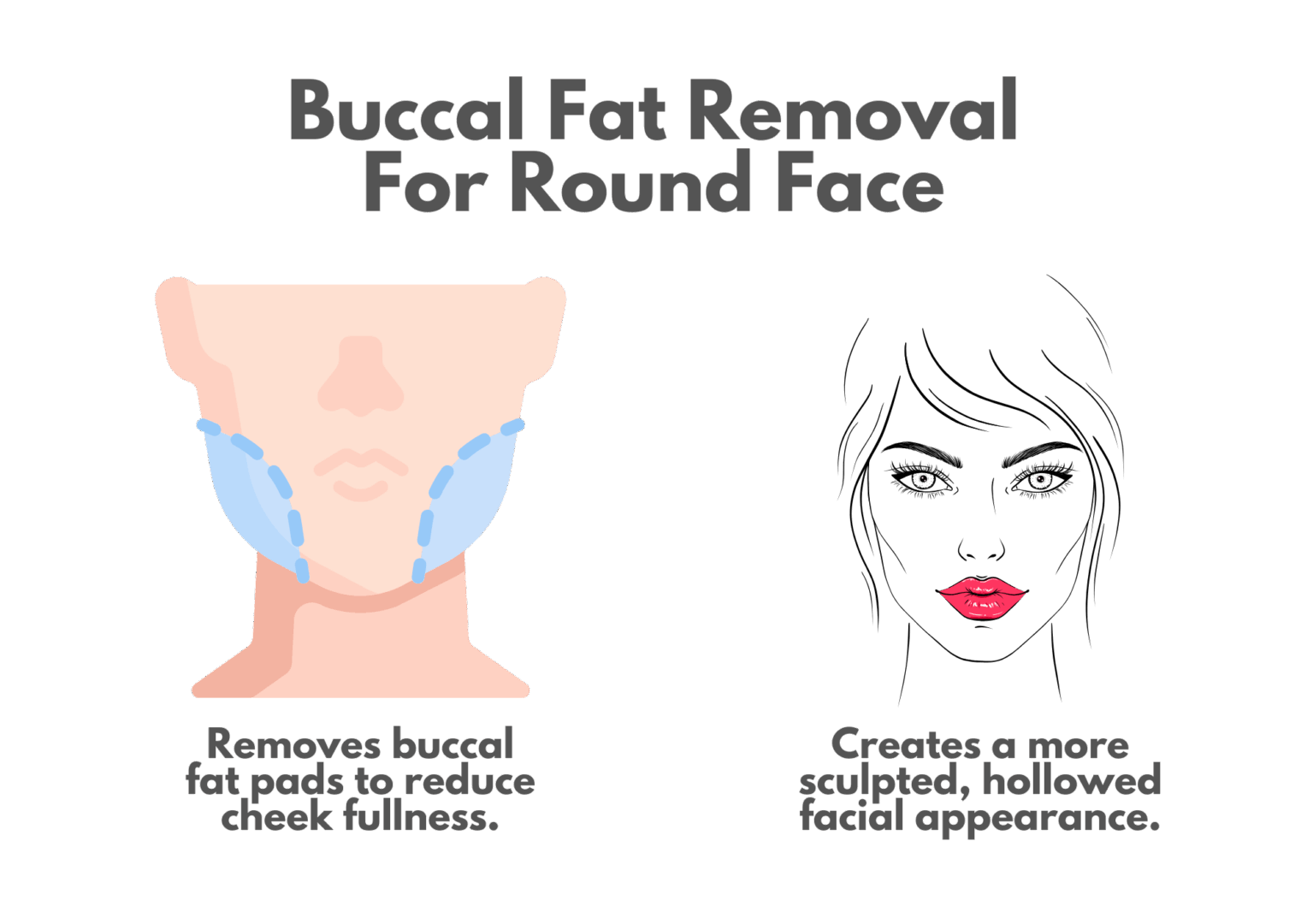 Buccal fat removal for a round face.