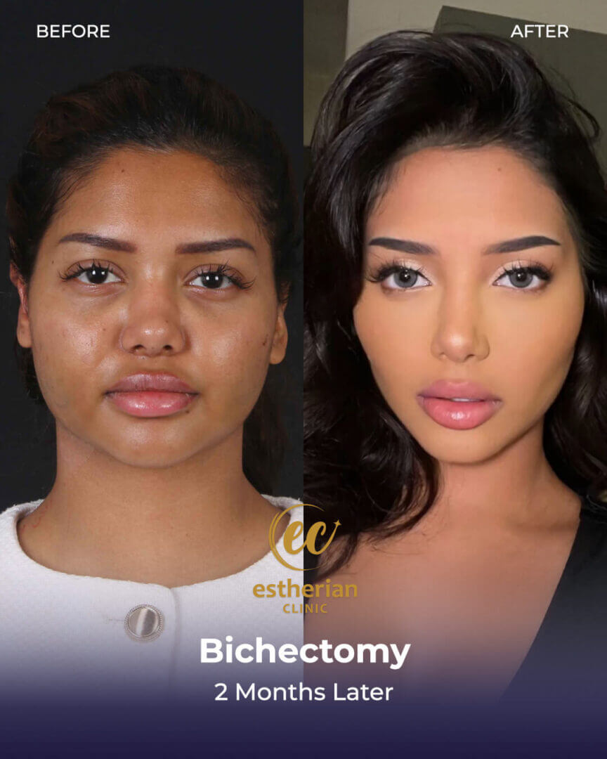 (Bichectomy results, 2 months later)