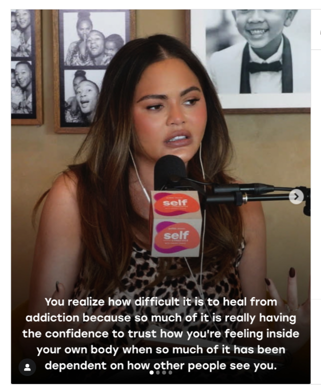 Chrissy Teigen after her hairline-lowering surgery