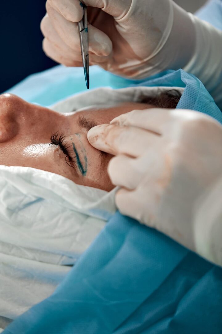 Close up of a patient undergoing Blepharoplasty