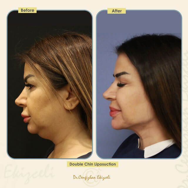 Double-chin liposuction from the Estherian Clinic (before and after)