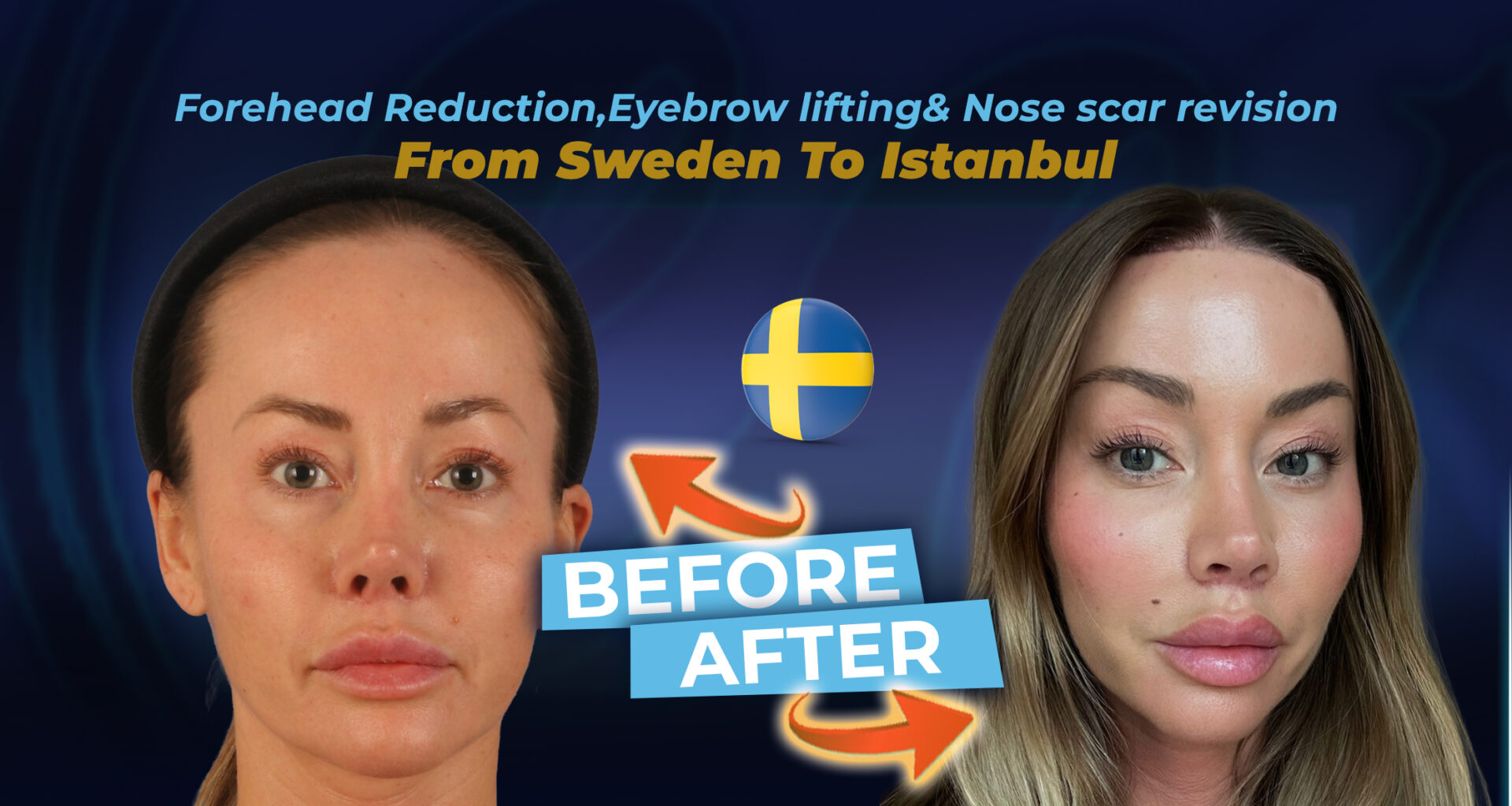 Forehead-Reduction-+-eyebrow-lifting-+-Nose-scar-revision-