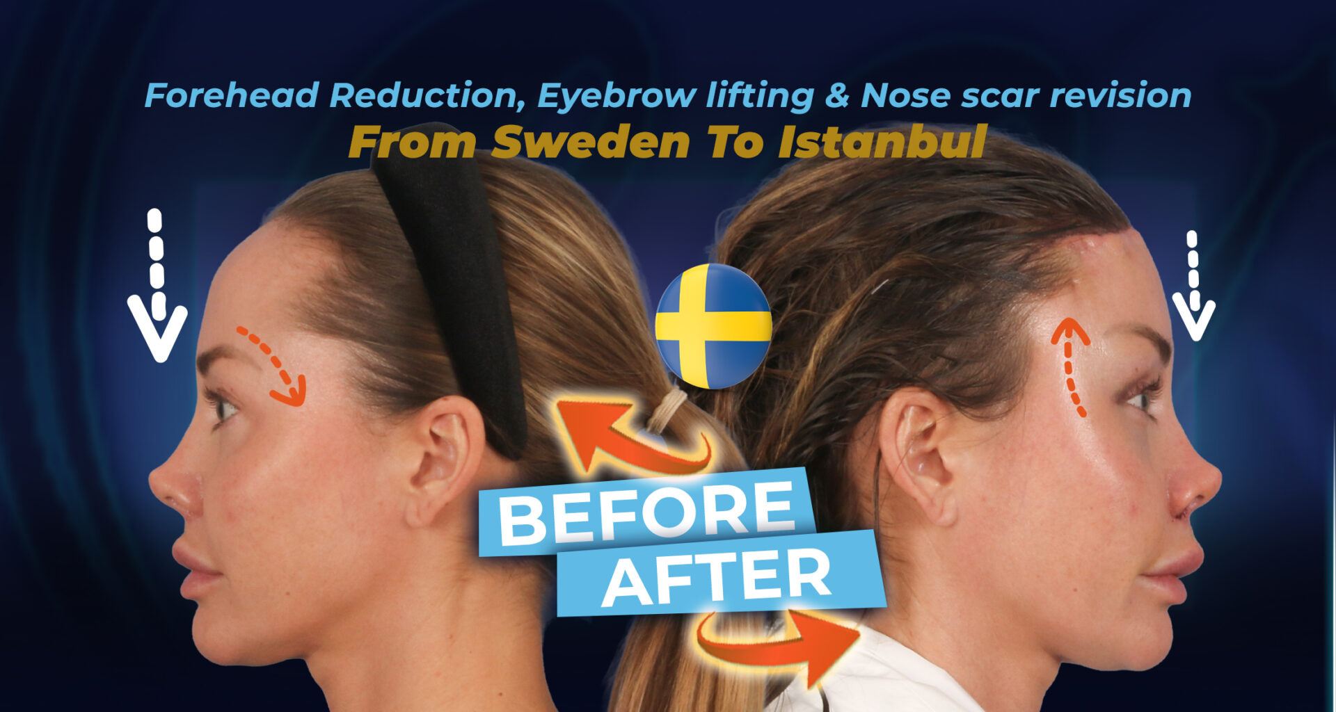Elinor-Izabella-Stahlv (patient success story about forehead reduction)