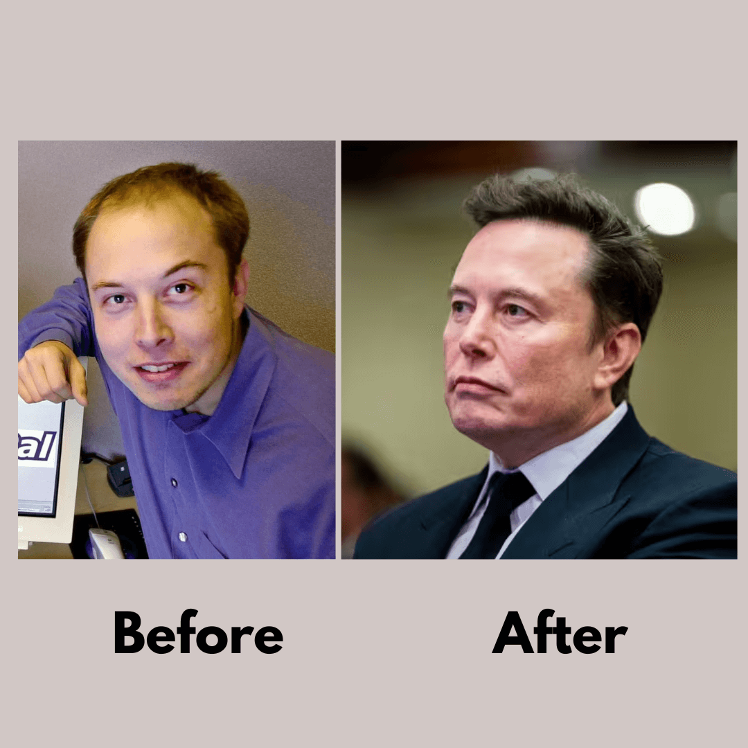 Infographic: Elon Musk Hair loss treatment