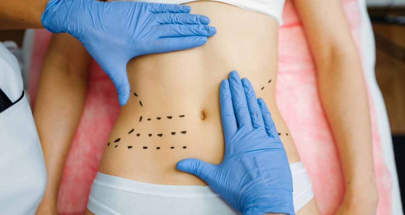 Emsculpt VS. Vaser Liposuction