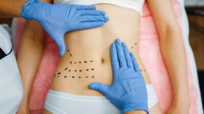 Emsculpt VS. Vaser Liposuction