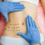 Emsculpt VS. Vaser Liposuction