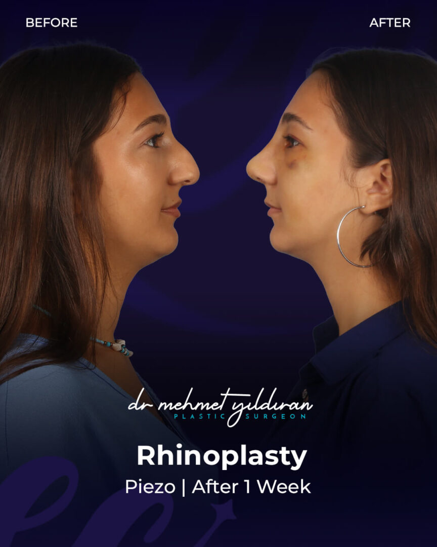 Ethnic Rhinoplasty Before-and-after Results by Dr. Mehmet Yildiran.