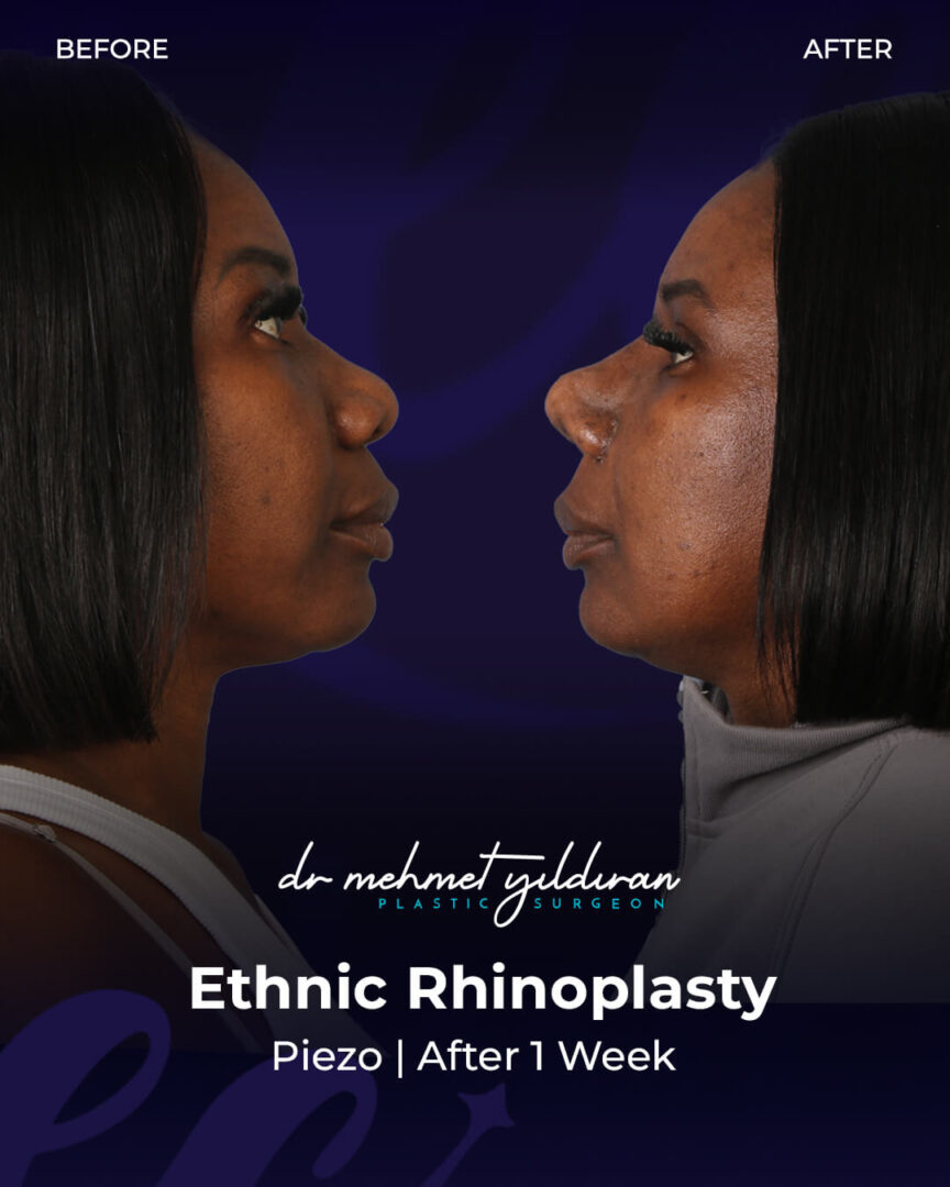 Ethnic Rhinoplasty for African Nose by Dr. Mehmet Yildiran