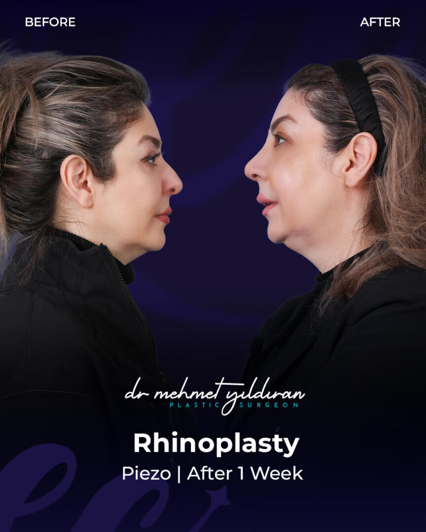Ethnic Rhinoplasty for Middle-eastern Nose by Dr. Mehmet Yildiran