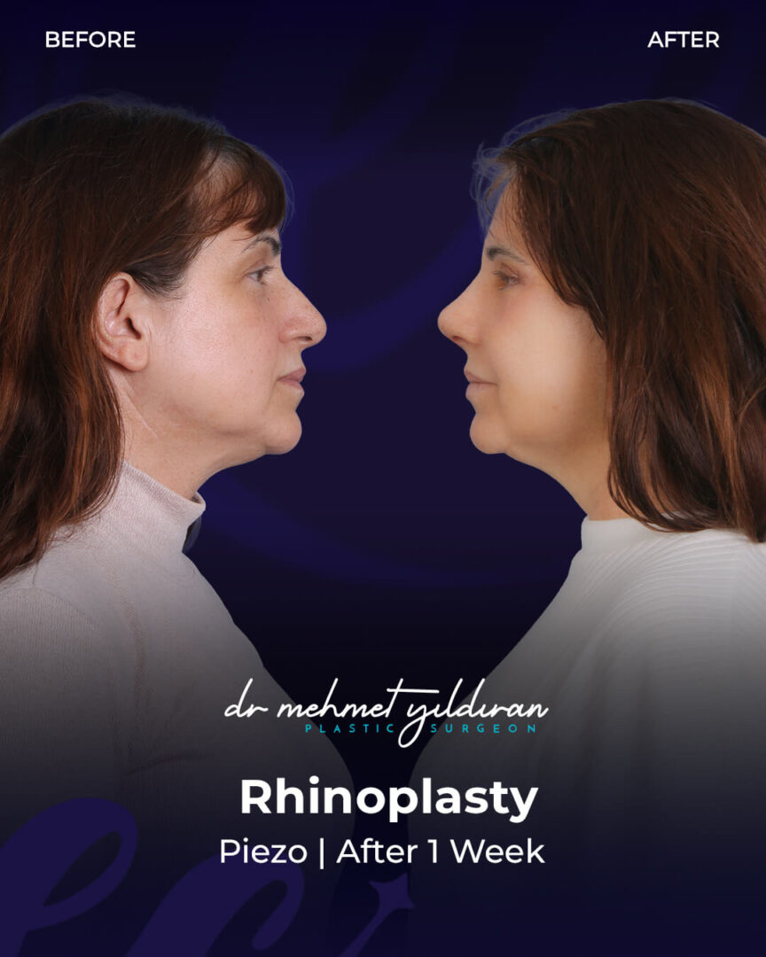 Ethnic Rhinoplasty for a Mexican Nose by Dr. Mehmet Yildiran.