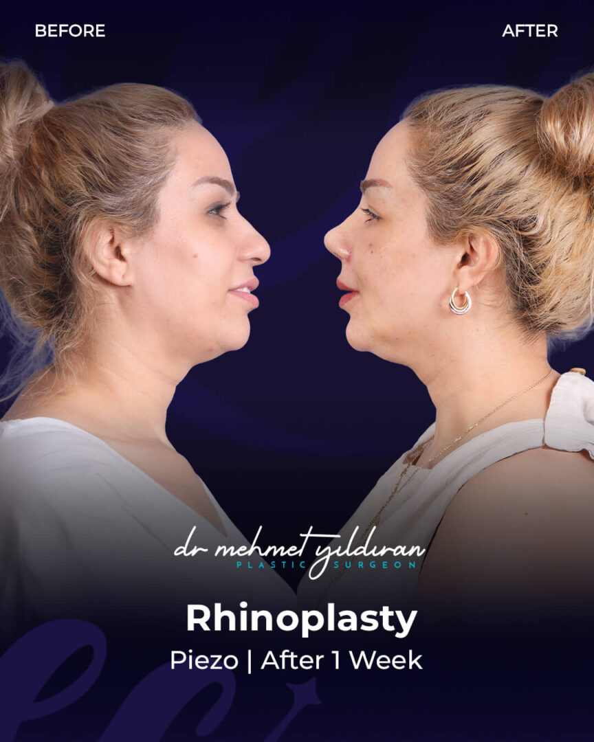 Ethnic Rhinoplasty for a Middle-eastern Nose by Dr. Mehmet Yildiran