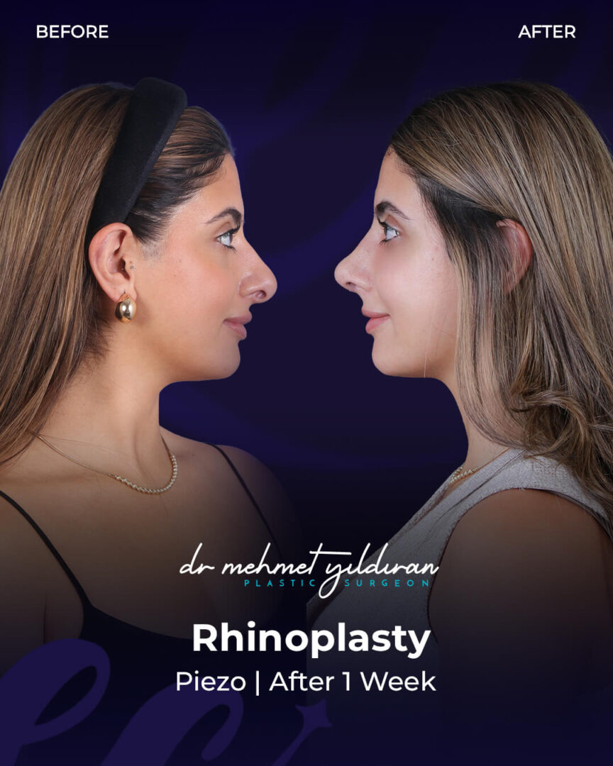 Ethnic Rhinoplasty (results) for a Middle-eastern Nose by Dr. Mehmet Yildiran.