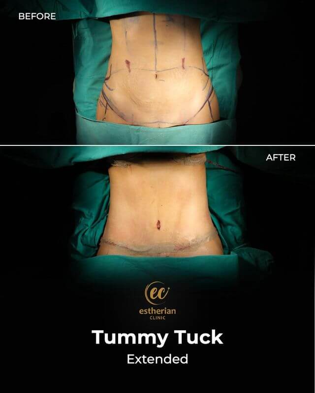 Extended Tummy Tuck (before and after)