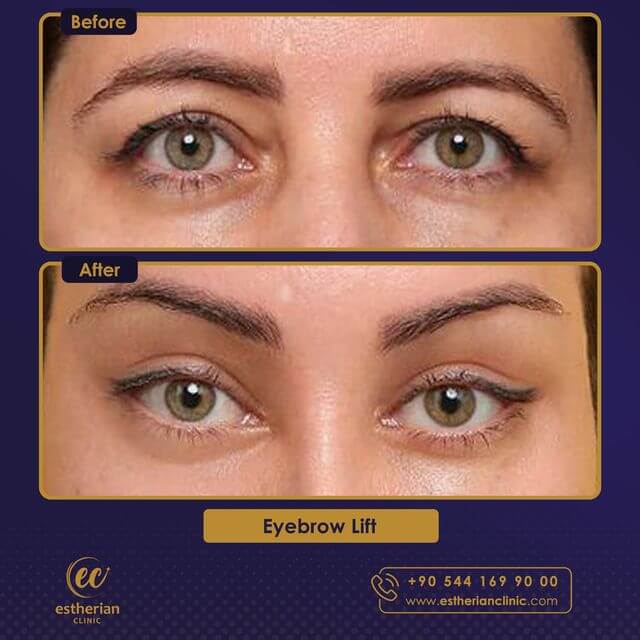 Eyebrow Lift before and after