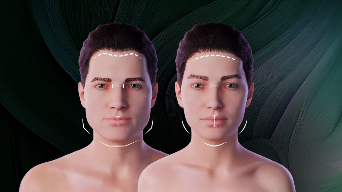 Facial Feminization Surgery (FFS)