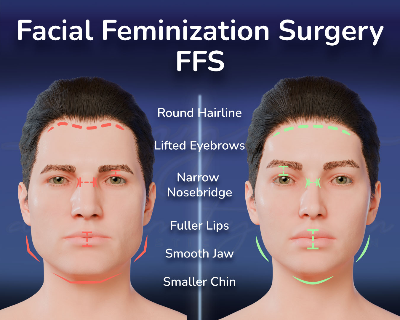 A 3-D Image Break Down of the Facial Feminization Surgery by Dr. Mehmet Yildiran