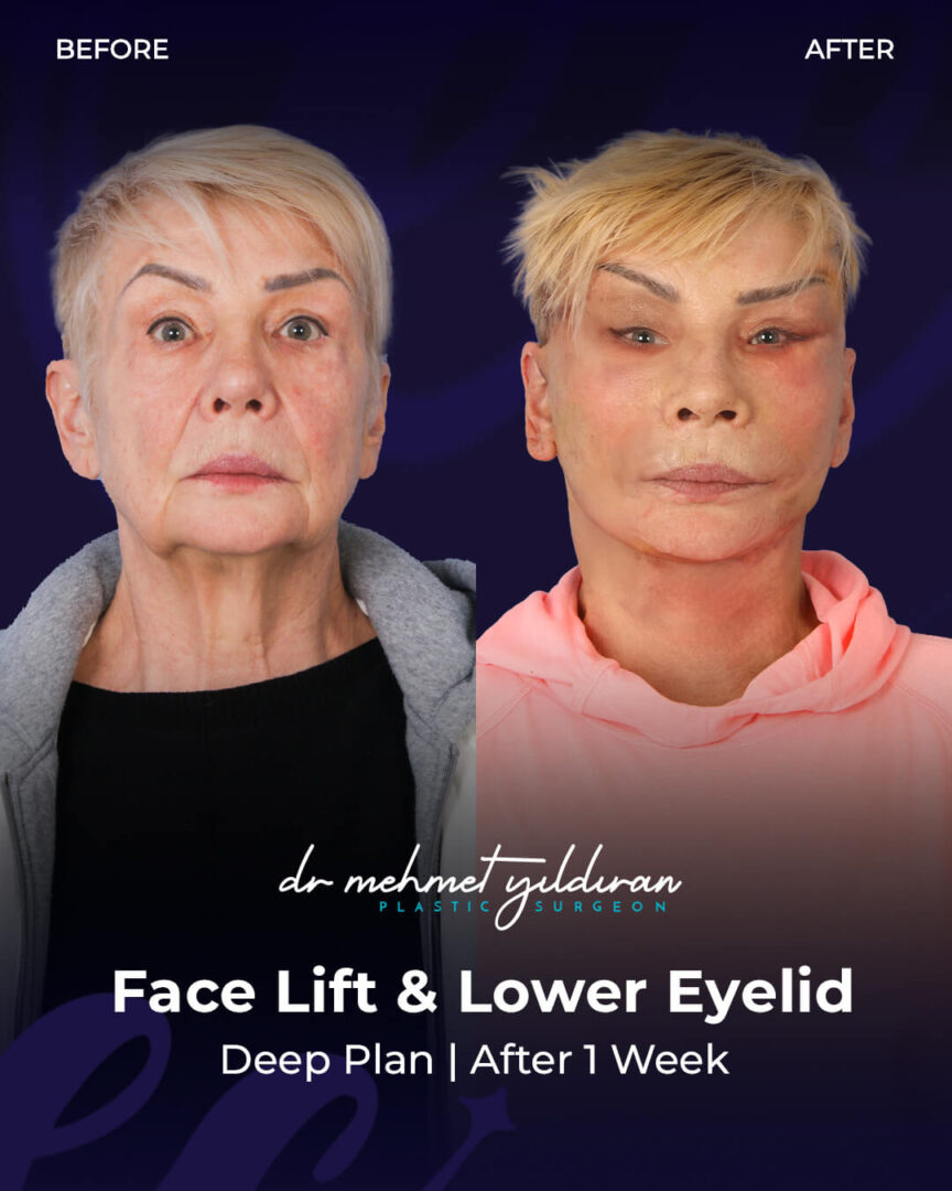 Face Lift and Lower Eyelid Lift Transformation by Dr. Mehmet Yildiran