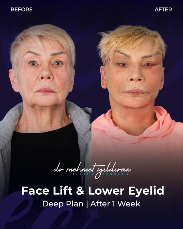 Face Lift and Lower Eyelid (deep plane) Results after 1 week by Dr. Mehmet Yildiran