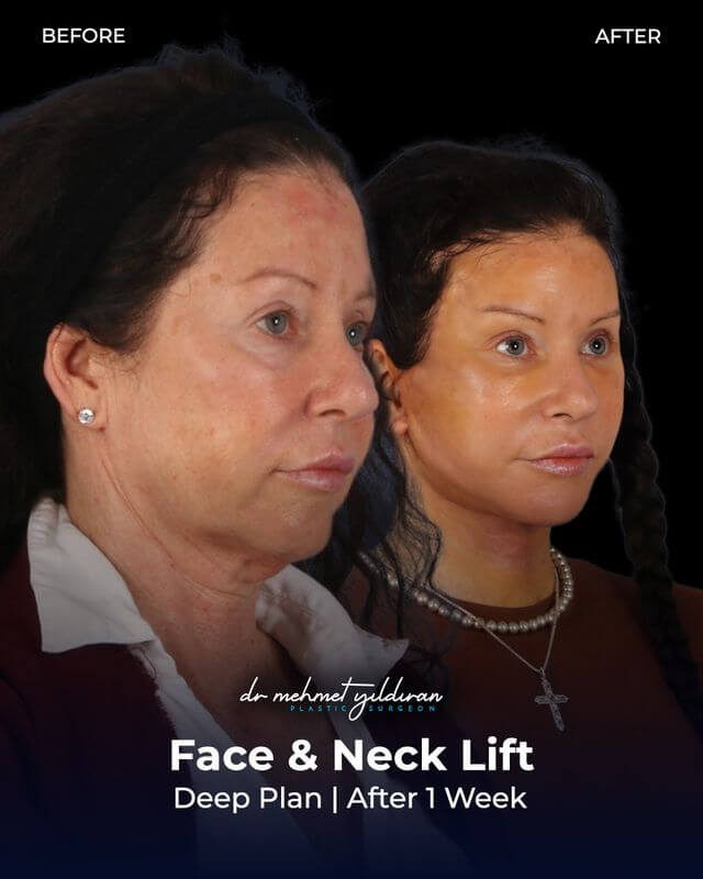 Face and Necklift (Deep plane) by Dr. Mehmet Yildiran (results after 1-week)