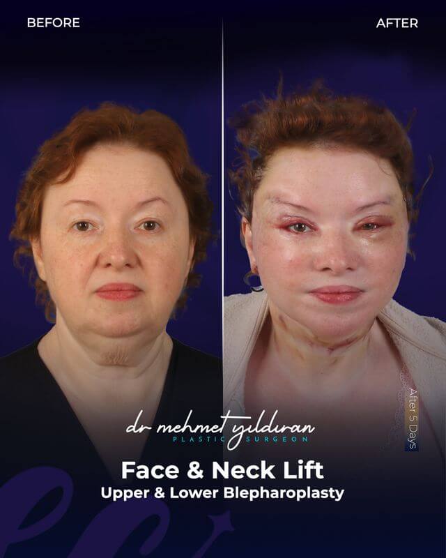 Face and Necklift as well as Upper and Lower Blepahroplasty by Dr. Mehmet Yildiran (results after 5-days)