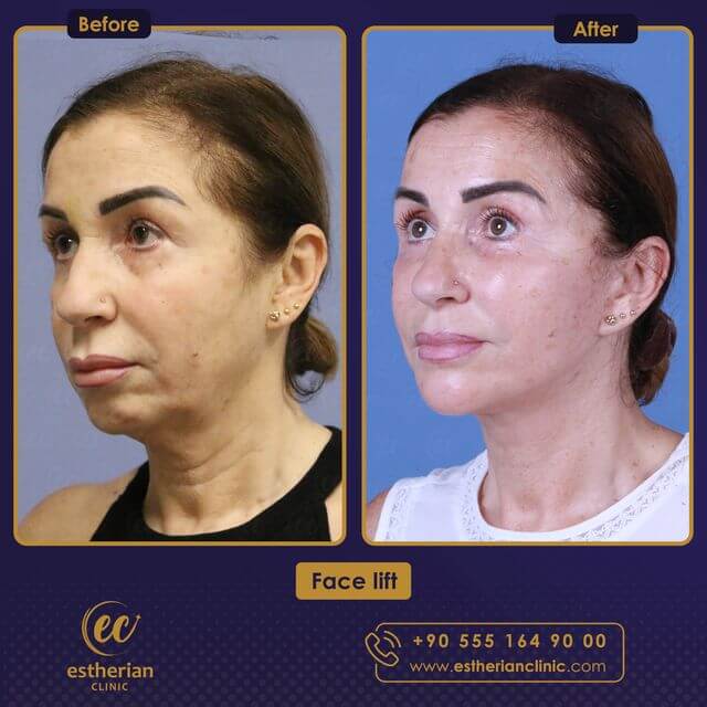 Facelift results by the Estherian Clinic (before and after)