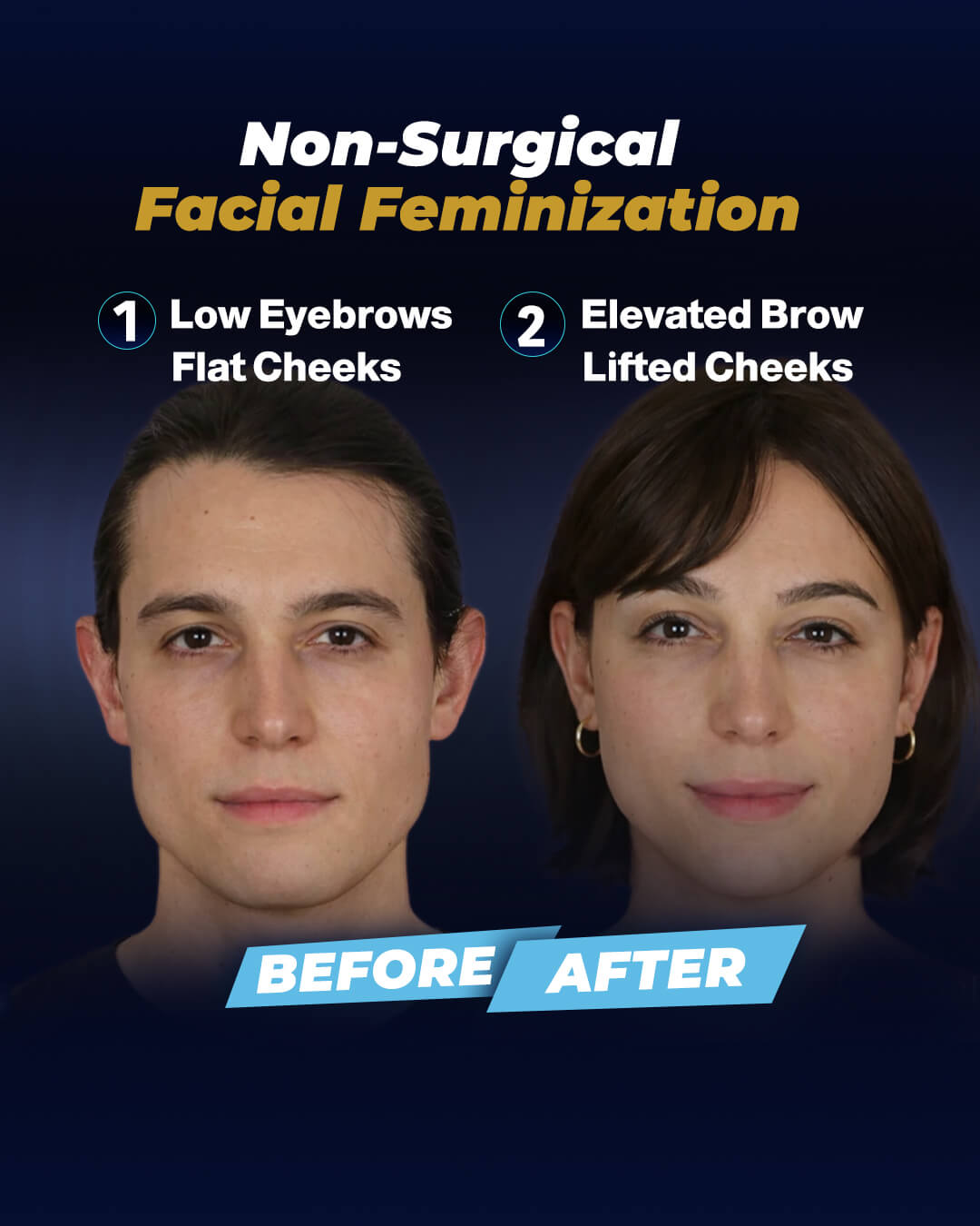 A Non-surgical Facial Feminization Inforgraphic by Dr. Mehmet Yildiran