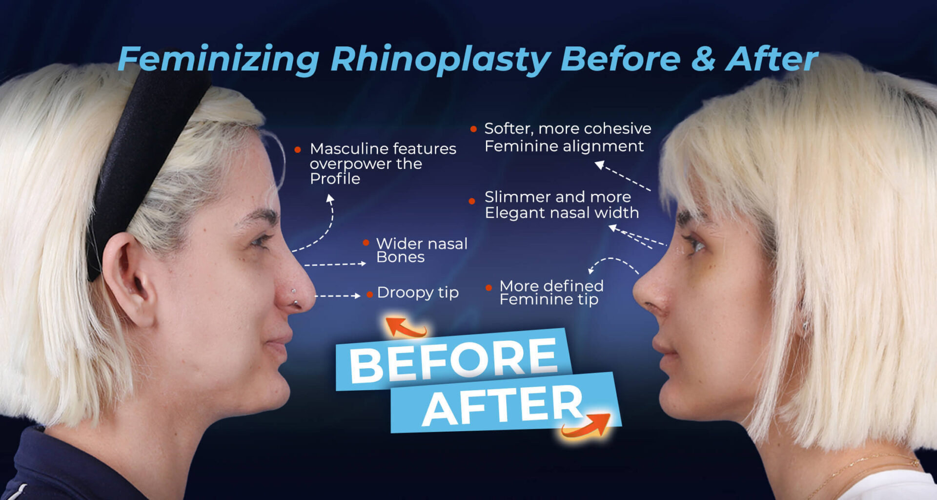 Feminizing-Rhinoplasty-Before-&-After