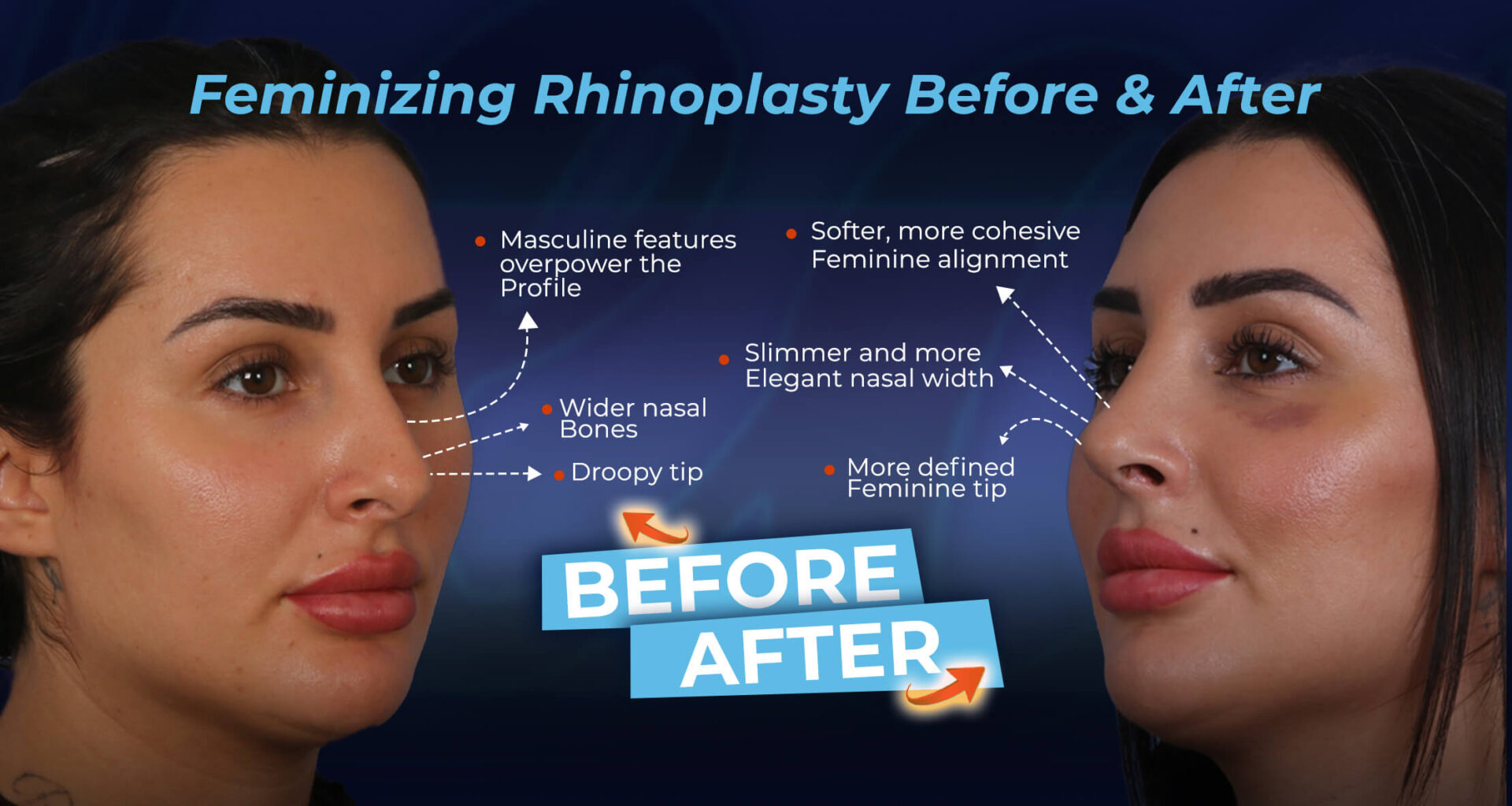 Feminizing-Rhinoplasty-Before-&-After Results (Part of Facial Feminization Surgery FFS)