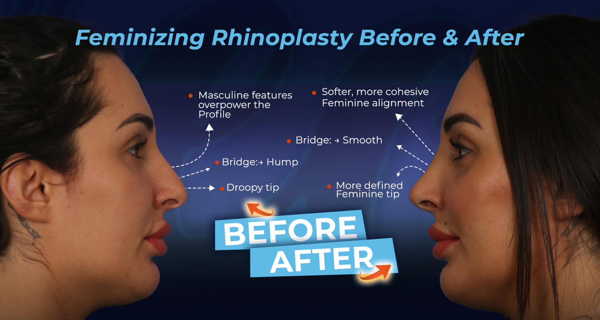 Feminizing-Rhinoplasty-Before-&-After Results (Part of Facial Feminization Surgery FFS)