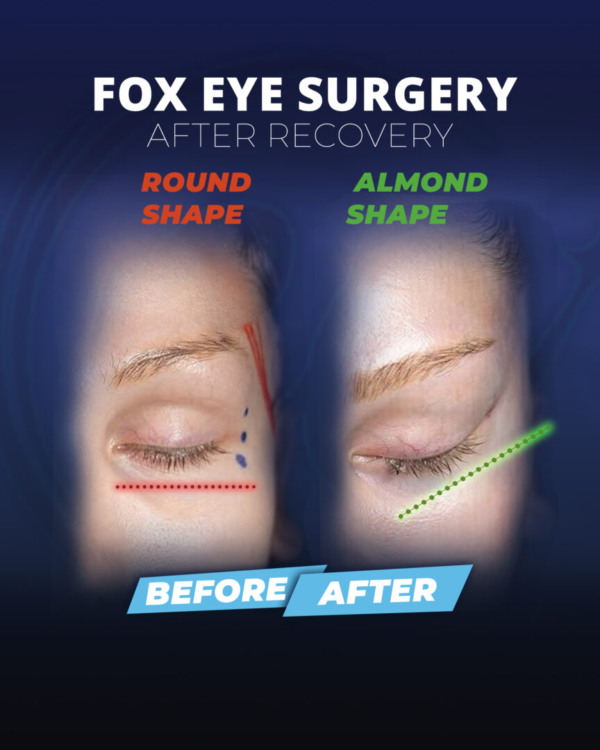 FoFox-Eye-Surgery-Recovery (results)