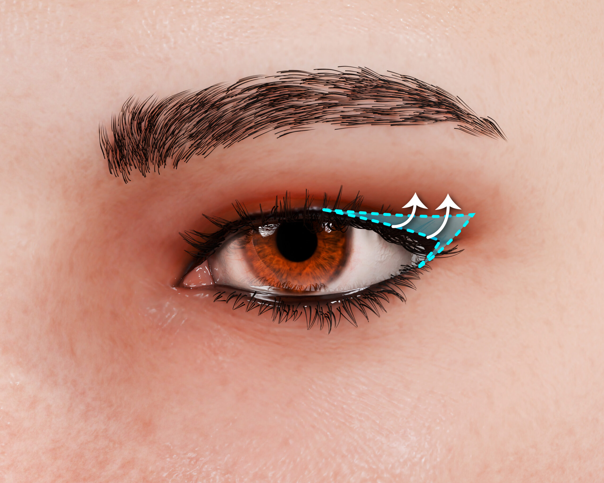 Fox-Eye-Surgery-Canthoplasty-Infographic