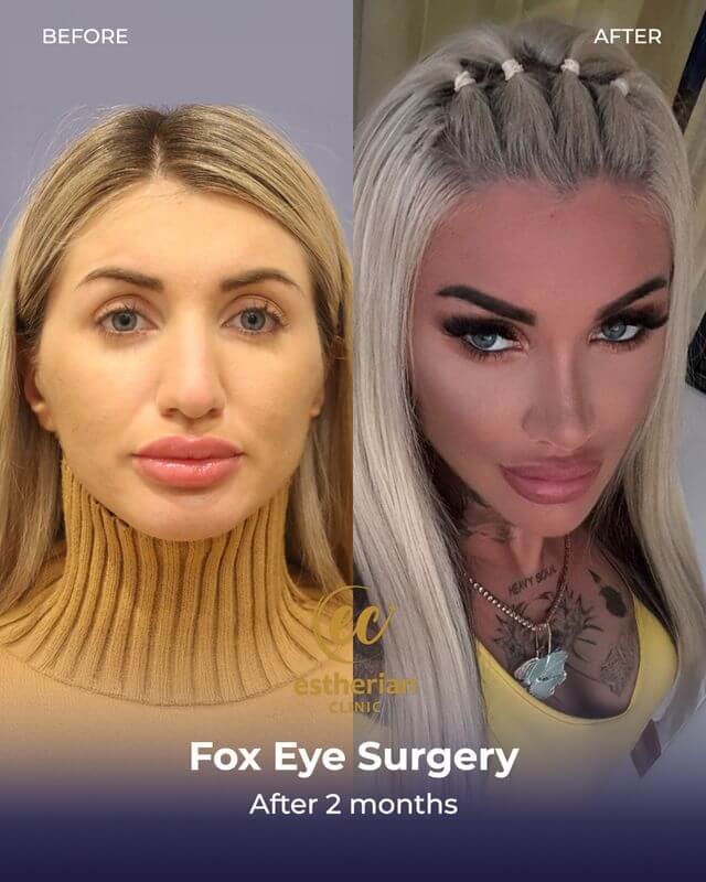 Fox Eye Surgery (before and after) results (2 months post-op) by the Estherian Clinic