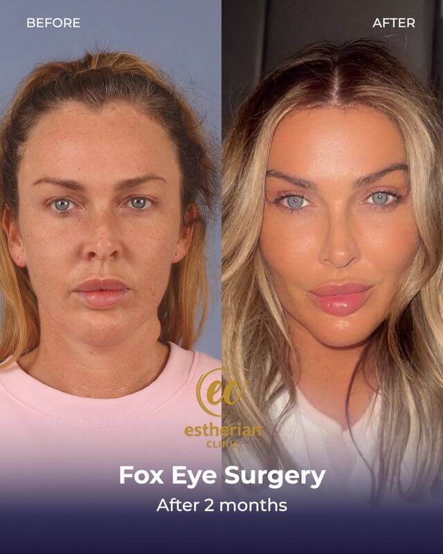 Fox Eye Surgery (before and after) results by the Estherian Clinic