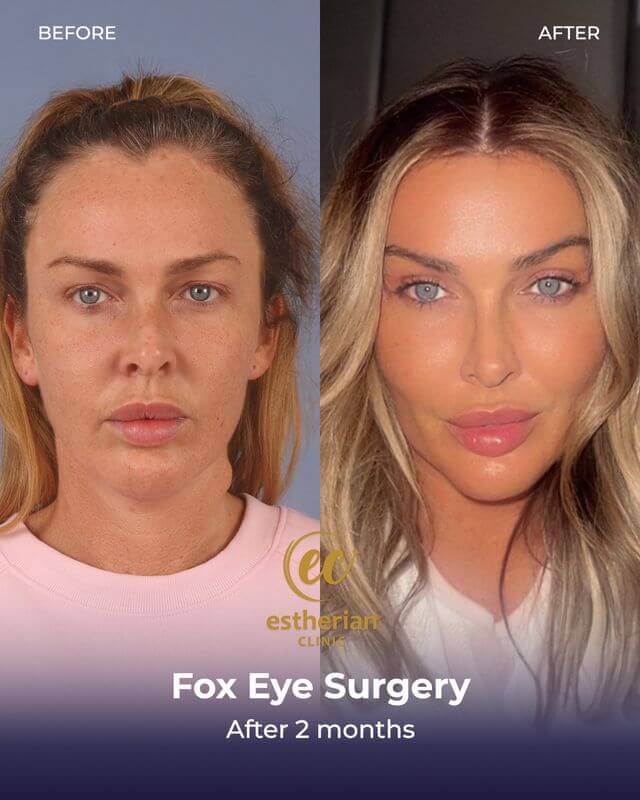 Fox eye surgery, Canthoplasty(after 2 months) before-and-after results by the Estherian Clinic
