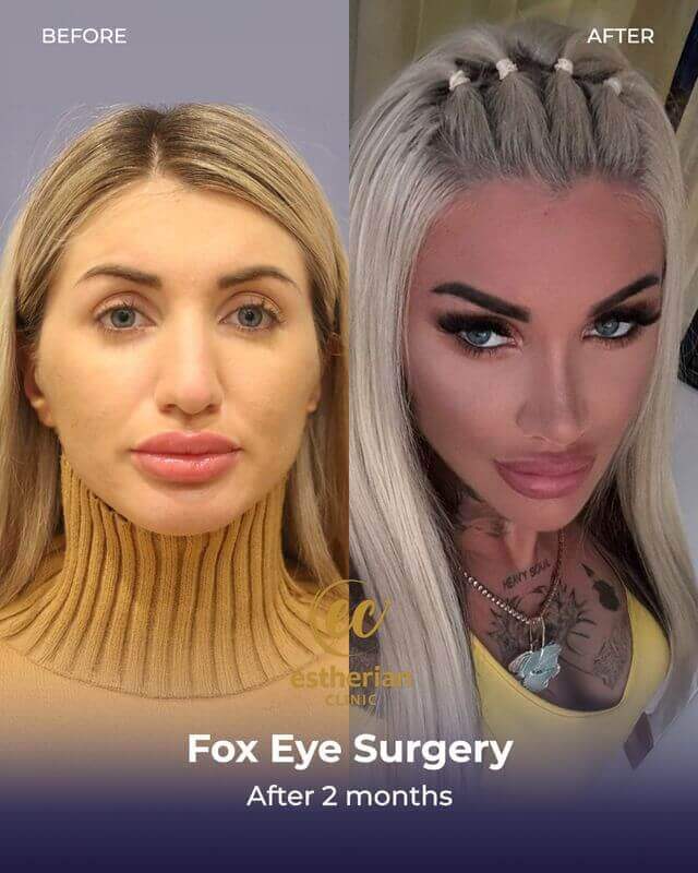 Fox eye surgery (after 2 months) before-and-after results by the Estherian Clinic